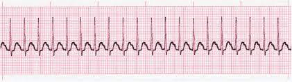 Ekg'de tüm pqrst dalga formları mevcut ve ritim düzenli svt'ye nasıl davranırsınız? Mycpdug Protocols Details