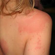 Pictures Of Skin Allergies In Children
