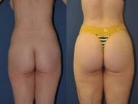 Sep 04, 2019 · 4 beauty aesthetics institute, inc. Brazilian Butt Lift Surgeon Constantino Mendieta