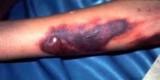 Image result for ‫علائم تب کریمه‬‎