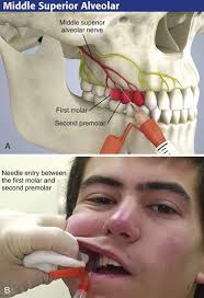 Image result for Periapical Block