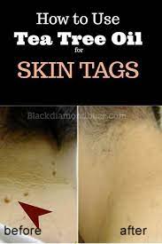 Tea Tree Oil For Skin Tags How To Easily Get Rid Of Skin Tags And Moles With Tea Tree Essential Oil Fast A Tea Tree Oil Uses Tea Tree Oil