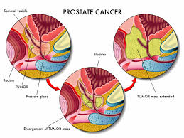 Although screenings for prostate cancer are one tool for early detecti. Prostate Cancer Exercise For Recovery Unison Health