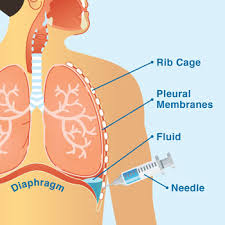 Image result for Thoracentesis