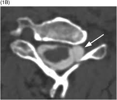 Oct 22, 2020 · the root canals travel from the tip of the tooth's root into the pulp chamber. Nerve Root Avulsion Case 35 Clinical Imaging Of Spinal Trauma