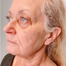 𝕃𝕚𝕢𝕦𝕚𝕕 𝔽𝕒𝕔𝕖 𝕃𝕚𝕗𝕥, Not ready for the knife? Come see me for  the needle & a non surgical facial rejuvenation! Ask for the 𝕃𝕚𝕢𝕦𝕚𝕕  𝔽𝕒𝕔𝕖 𝕃𝕚𝕗𝕥 & I’ll pull out the syringes! , 2 syringes of Voluma in  cheeks, ...