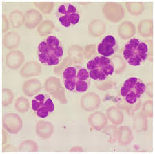 Histology Look A Like 117 Adult T Cell Leukemia V Purple Medical Laboratory Medical Laboratory Science Hematology