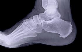 Image result for Foot XRay