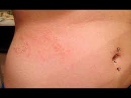 Youtube Scabies Scabies Rash Scabies Images