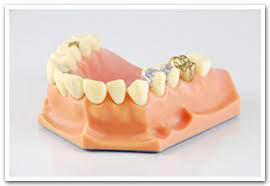 The size and shape of your surrounding teeth can be duplicated. Should Old Dental Crowns Be Replaced Southfield Dentist Family And Cosmetic Dentistry