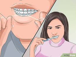 However, most dental work is a bit uncomfortable, and you can expect a bit of soreness when the brackets are removed. How To Prepare For Getting Braces Removed 12 Steps