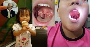 Implikasi yang lain dapat dilihat. Aiskrim Tak Boleh Sembuhkan Tonsil Kata Doktor Ini Tetapi Ia Mengurangkan Kesakitan Kerengkung Pa Ma