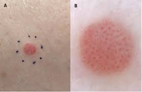 Image result for Spitz Nevus
