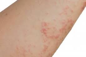 Image result for scabies symptoms