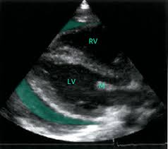 Journal of the american college of cardiology vol. Myocarditis Amboss