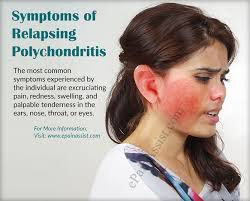 Image result for Relapsing Polychondritis