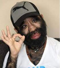 L'homme le plus poilu du monde. En Images L Un Des Hommes Les Plus Poilus Du Monde