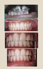 How long do you need to wear a retainer? Need Help A Gap Between My Lower And Upper Teeth Formed Ortho Said My Bite Changed And He Cannot Do Much About It I Wear Permanent Retainers On Both Lower And Upper Teeth But I