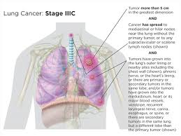 Weight loss is also almost universal, and it occurs even when people are eating a diet with adequate calories. Lung Cancer Staging Lungevity Foundation