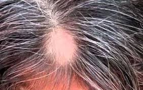 سعفة في البشر العلاج وأعراض الصورة المرحلة الأولية