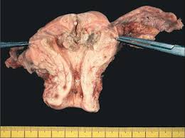Examples include irregular ovulation patterns, which might happen in polycystic ovary syndrome, obesity and diabetes. References In Endometrial Cancer The Lancet