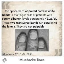 Image result for Muehrcke Line