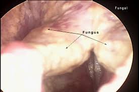 Image result for Acute Laryngitis
