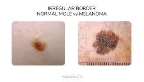 Pictures of skin cancer in people of color. Melanoma Pictures Skin Melanomas Vs Non Cancerous Moles