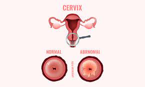 Very rarely, ovarian cancer cells can be detected during a pap test. What Is A Pap Smear Garden Ob Gyn Obstetrics