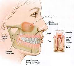 Early stage wisdom teeth real pictures. Wisdom Teeth Kids Dental In Plano And Carrollton Dr Jeff Holt