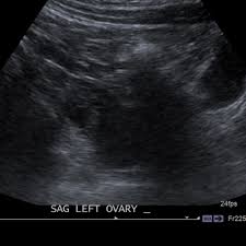 Don't get surprised when you arrive for your female pelvic ultrasound. Transvaginal Ultrasound Cedars Sinai