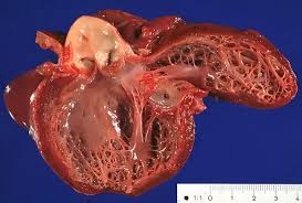 Image result for Cardiomyopathy