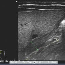 Us Evaluation Of Infantile Hypertrophic Pyloric Stenosis