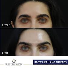 Browlift – Dr. Georges Ziade Clinics