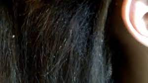 White piedra (wp) is a rare superficial mycosis that has been poorly described in the literature. White Piedra Hair Fungus Youtube