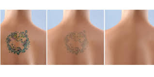Tattooentfernung Kosten Fur Tattoo Entfernen Mit Laser In Wien