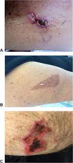 Liquefactive necrosis is a form of necrosis in which dead tissue turns into a liquid substance. Subcutaneous Immunotherapy Induced Local Skin Necrosis The Journal Of Allergy And Clinical Immunology In Practice
