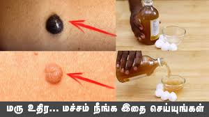 The first thing you should always do is to see your doctor to get it likewise, some people choose to remove their moles for cosmetic reasons especially if they appear in very visible places on the body such as the face or. Remove Skin Tag And Mole Without Surgery Nature Nurture Youtube