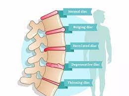 Search picture of bulging disc. Herniated Disc Treatment Dr Auchter No Surgery