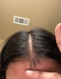 Even the young generation has fallen prey to thinning hair and have been hard put. I Cut Off My Widows Peak 4 Yrs Ago I Used To Trim It Every Week I Ve Been Growing It Back Since The Past Few Weeks Will It Magically Grow Back