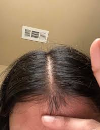 Even the young generation has fallen prey to thinning hair and have been hard put. I Cut Off My Widows Peak 4 Yrs Ago I Used To Trim It Every Week I Ve Been Growing It Back Since The Past Few Weeks Will It Magically Grow Back