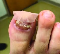 Image result for Onycholysis feet