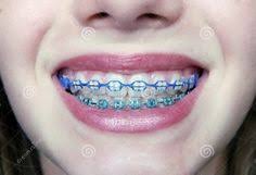 Black And Baby Blue Braces Blue And Green Braces Colors Dental Braces Teeth Braces