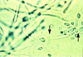 Candida Vulvovaginitis
