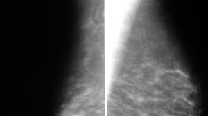 Poland syndrome is a genetic disorder which occurs due to unknown reasons and is characterized by absence or underdevelopment of the chest muscles and webbed fingers in one side of the body. Poland Syndrome Radiology Case Radiopaedia Org