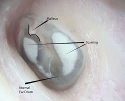 Ruptured eardrum,tinnitus and meniere disease and otitis media in asian woman. Tympanosclerosis Mcgovern Medical School