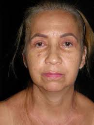 Laser vs. Traditional Blepharoplasty in Patients with Fitzpatrick III to VI