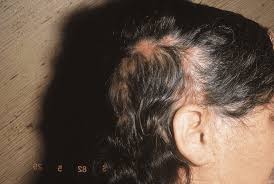 Traitement du lupus érythémateux discoïde