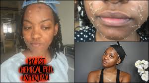 It works best for hyperpigmentation as well. Chemical Peel Experience 1 How I Removed My Dark Spots Darkspotremoval Youtube