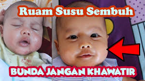 Tanpa reaksi seperti itu, ruam pada pipi bayi tidak memerlukan penanganan medis yang serius. Cara Menyembuhkan Ruam Susu Pada Bayi Youtube